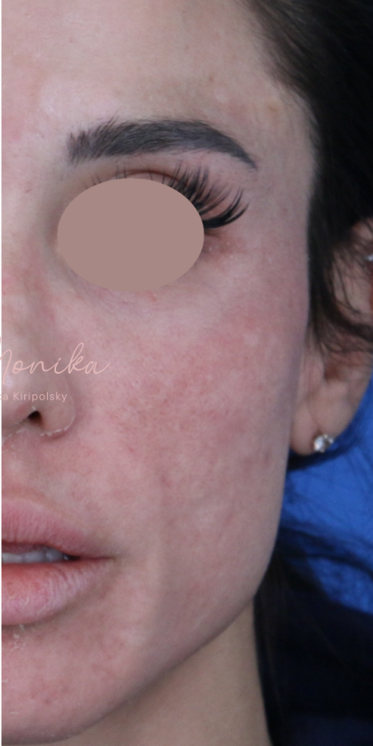 Hyperpigmentation Before & After Patient #1843