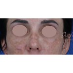Chemical Peel Before & After Patient #1843