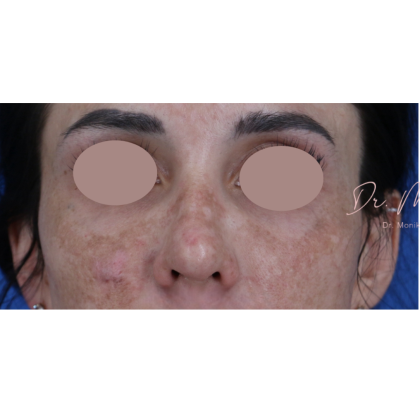 Chemical Peel Before & After Patient #1843