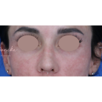 Chemical Peel Before & After Patient #1843