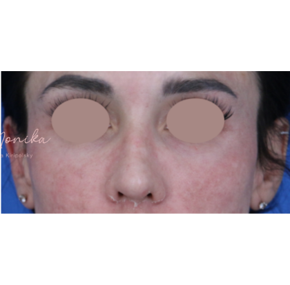 Chemical Peel Before & After Patient #1843