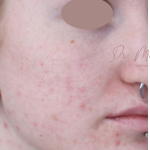 Acne Scarring Before & After Patient #1868