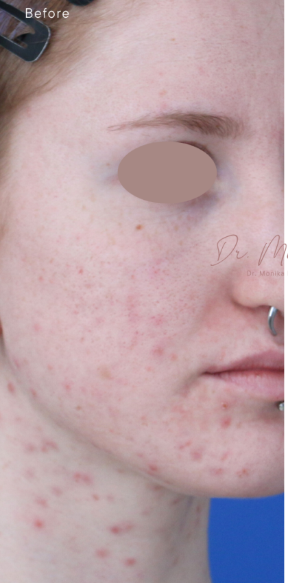 Acne Scarring Before & After Patient #1868