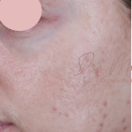 Acne Scarring Before & After Patient #1897