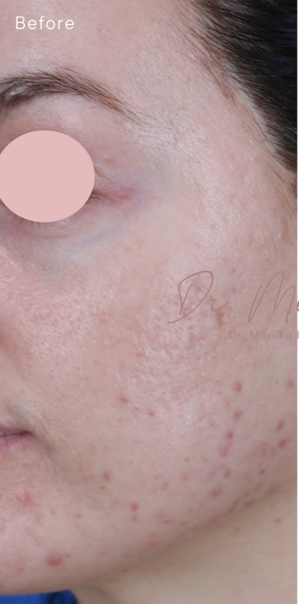 Acne Scarring Before & After Patient #1897