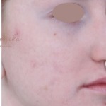 Acne Scarring Before & After Patient #1868