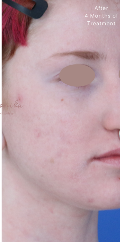 Acne Scarring Before & After Patient #1868