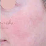 Acne Scarring Before & After Patient #1897