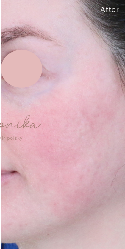 Acne Scarring Before & After Patient #1897