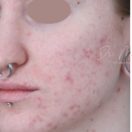 Acne Scarring Before & After Patient #1868