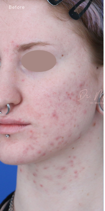 Acne Scarring Before & After Patient #1868