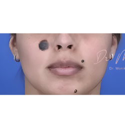 Mole & Melanoma Removal Before & After Patient #2051