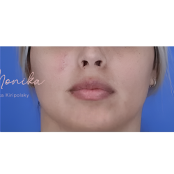 Mole & Melanoma Removal Before & After Patient #2051