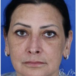 Melasma Before & After Patient #2061