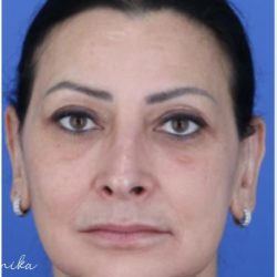 Melasma Before & After Patient #2061
