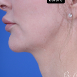 ResurFX Before & After Patient #2068