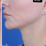 ResurFX Before & After Patient #2068
