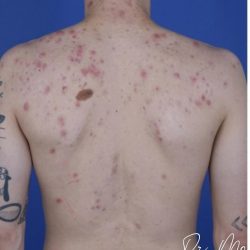 Back Acne Before & After Patient #2087