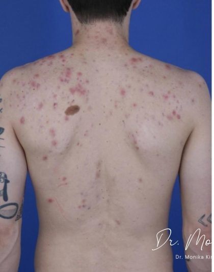 Back Acne Before & After Patient #2087