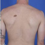Back Acne Before & After Patient #2087