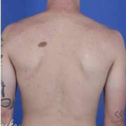 Back Acne Before & After Patient #2087