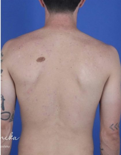 Back Acne Before & After Patient #2087