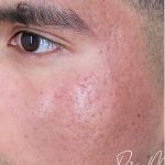 ResurFX Before & After Patient #2203