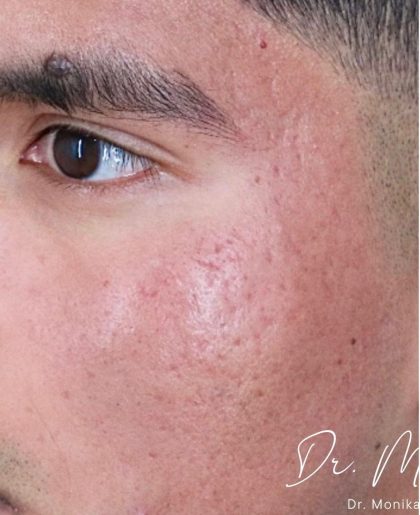 ResurFX Before & After Patient #2203