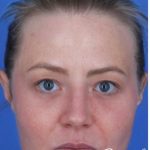 ResurFX Before & After Patient #2198