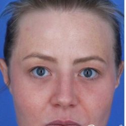 ResurFX Before & After Patient #2198