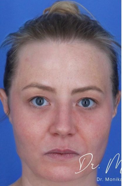 ResurFX Before & After Patient #2198