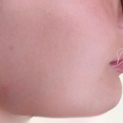 Chin & Jawline Facial Rebalancing Before & After Patient #2195