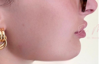 Chin & Jawline Facial Rebalancing Before & After Patient #2195