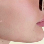 Chin & Jawline Facial Rebalancing Before & After Patient #2195