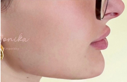 Chin & Jawline Facial Rebalancing Before & After Patient #2195