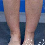 Liposuction / Liposculpture Before & After Patient #2190