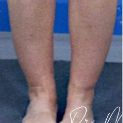 Liposuction / Liposculpture Before & After Patient #2190