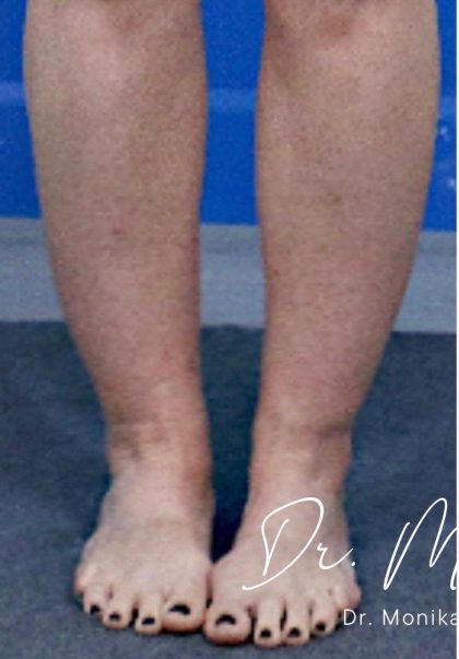 Liposuction / Liposculpture Before & After Patient #2190
