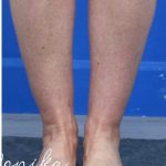 Liposuction / Liposculpture Before & After Patient #2190