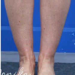 Liposuction / Liposculpture Before & After Patient #2190