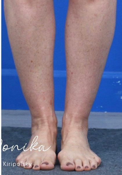 Liposuction / Liposculpture Before & After Patient #2190