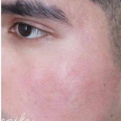 ResurFX Before & After Patient #2203