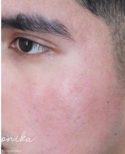 ResurFX Before & After Patient #2203