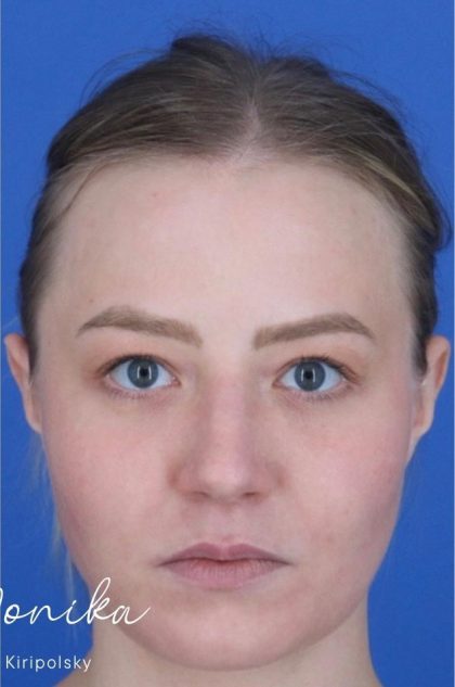 ResurFX Before & After Patient #2198