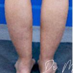 Liposuction / Liposculpture Before & After Patient #2190