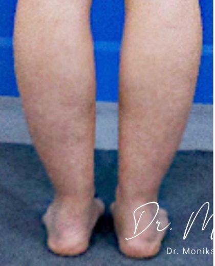 Liposuction / Liposculpture Before & After Patient #2190