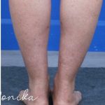 Liposuction / Liposculpture Before & After Patient #2190