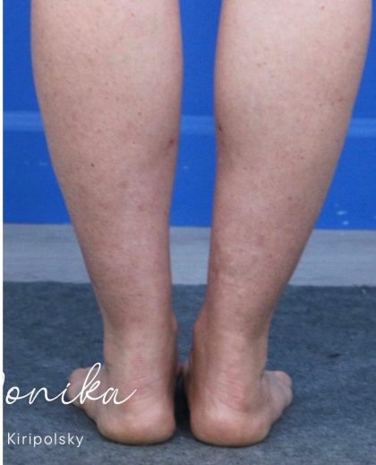 Liposuction / Liposculpture Before & After Patient #2190