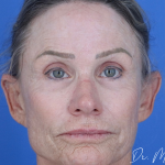 Chemical Peel Before & After Patient #2185