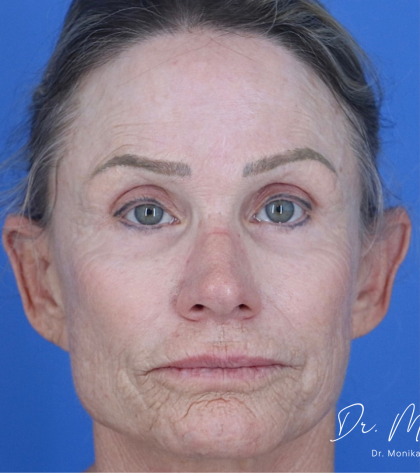 Chemical Peel Before & After Patient #2185